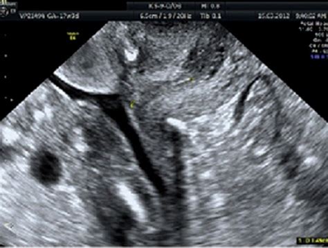 Cervical length with cerclage in situ by transvaginal ultrasound ...