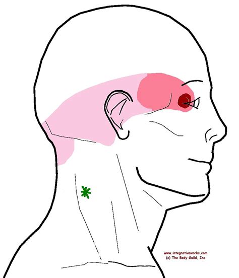 Neck-ache Headache, Eye-ache - Integrative Works | Trigger points neck ...