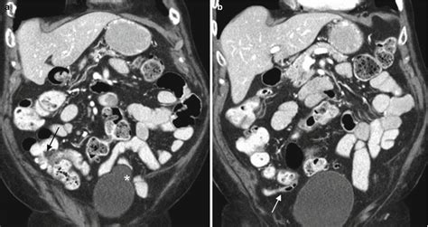 The Appendix | Radiology Key