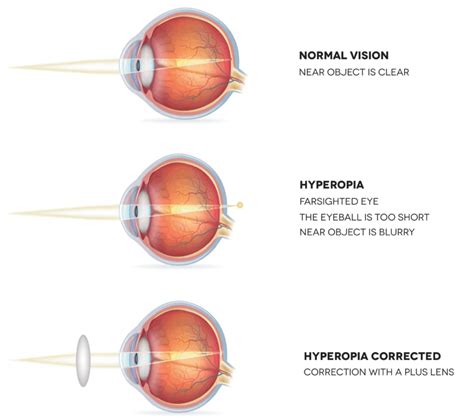 Hypermetropia | What is it, Causes and Treatment