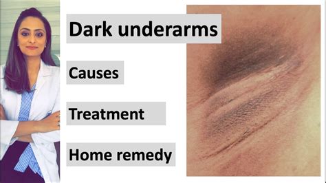 How to get rid of Dark underarms | causes| treatment| home remedy ...