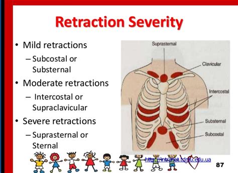 intercostal retractions - USA News Collections