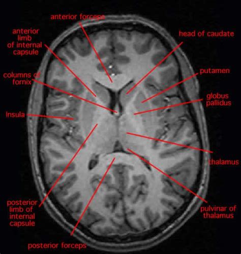 Depicts putamen, globus pallidus, thalamus, caudate nucleus, internal capsule, insula, and ...