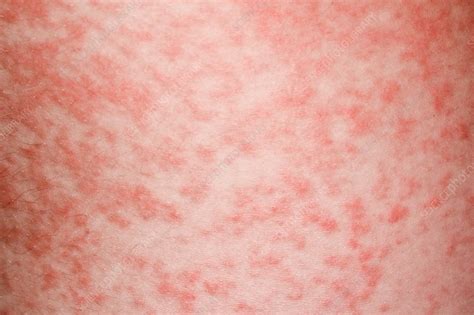 Amoxicillin rash in glandular fever - Stock Image - C034/5320 - Science Photo Library