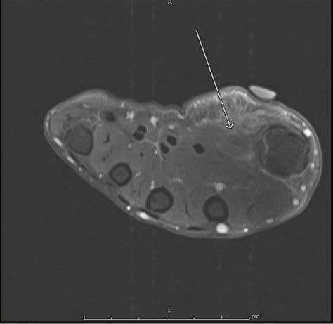 Epithelioid sarcoma | BoneTumor.org