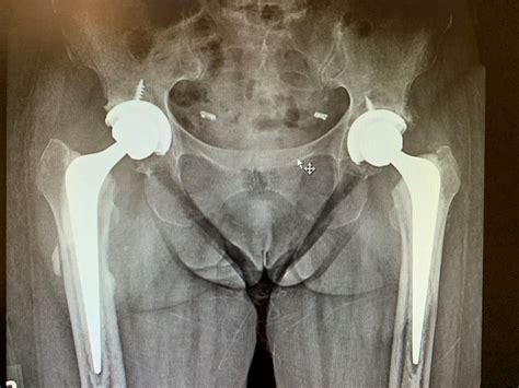 Case Study: Bilateral hip replacement in 66 year old female | Complete ...