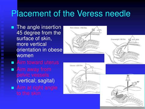 PPT - Safe Laparoscopic Access: technologies and techniques PowerPoint Presentation - ID:1034980