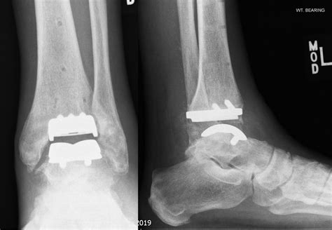 Ankle replacement or ankle fusion: Which surgery is best for ankle ...