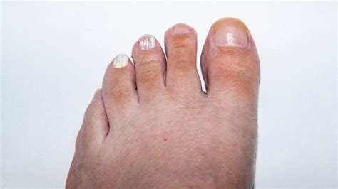 White Superficial Onychomycosis – Fungus Therapy – fungustherapy.com