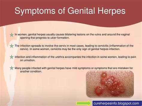 Genital Herpes Symptoms - Bing images