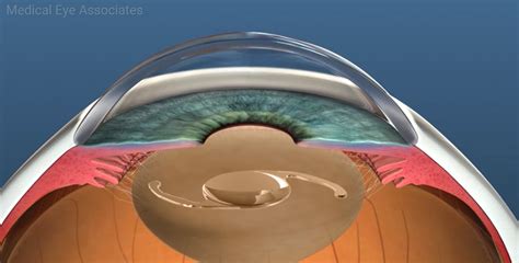 IOL Lens Implant. - Medical Eye Associates