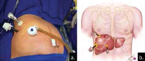 SciELO - Brasil - Laparoscopic transthoracic liver resection Laparoscopic transthoracic liver ...