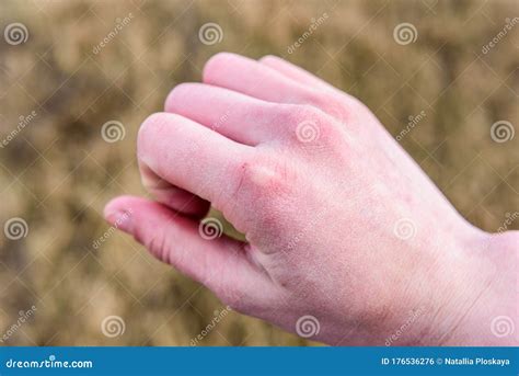 Dry, chapped skin on hand. stock photo. Image of body - 176536276