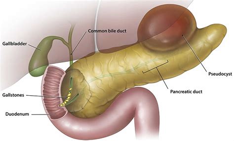 Pancreatic pseudocyst causes, symptoms, diagnosis, treatment & prognosis