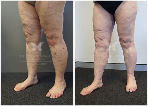 Thigh Lift Gallery | Before and After | Dr Reddy Sydney