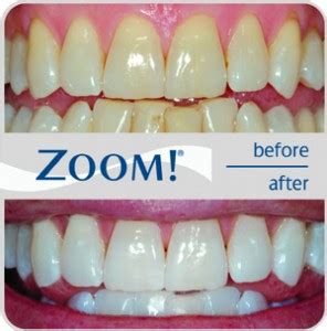 Take Home Teeth Bleaching Trays - Custom Home Tooth Whitening System