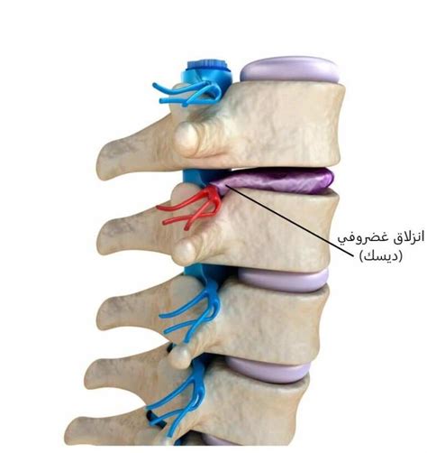 4 علامات قد تشير أن سبب آلام الظهر انزلاق غضروفي (ديسك) - طب اليوم