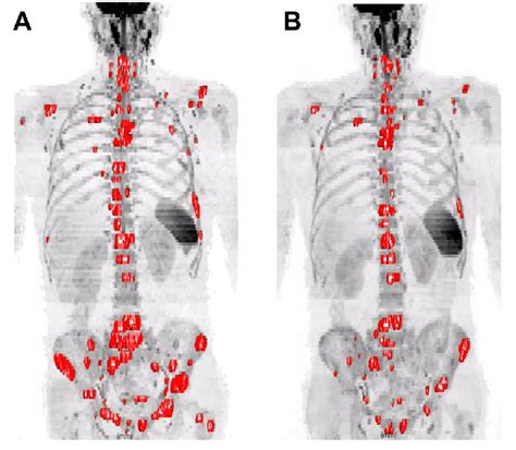 Whole-body diffusion weighted images in a woman with metastatic breast... | Download Scientific ...