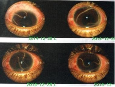 Loiasis (African Eye Worm) Clinical Presentation: History, Causes, Physical Examination