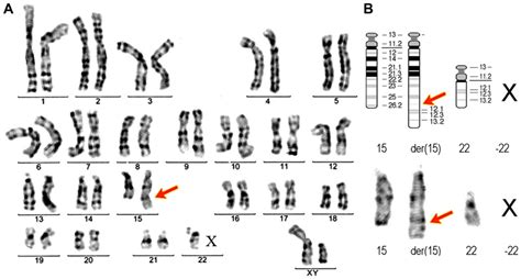 Translocation Down Syndrome Karyotype