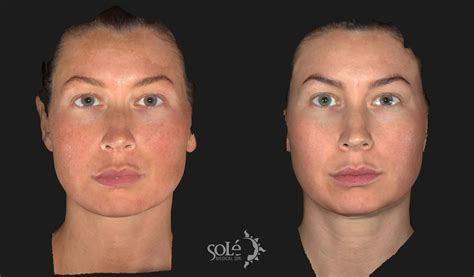 Laser Skin Rejuvenation Before and After Pictures Case 9 | Tifton, Albany & Valdosta, GA | Solé ...