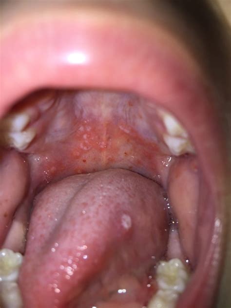 Hand Foot Mouth Disease versus Herpangina | Firas Blog