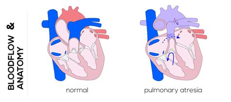 Congenital Defects Tutorial - Congenital Heart Defects | Atlas of Human ...