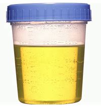 New Urine Test for Prostate Cancer Available; Unlike PSA Test, is Ultra-Specific for Prostate ...