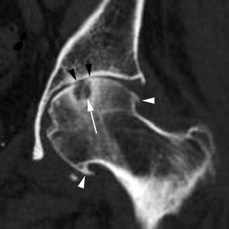 Imaging of Osteoarthritis | Radiology Key