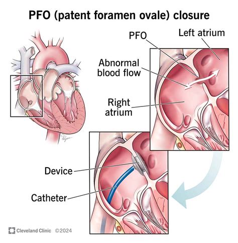 Patent Foramen Ovale (PFO): Symptoms, Causes & Treatment