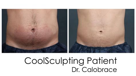 Liposuction vs. Coolsculpting®-- Which is Right for Me? - YouTube