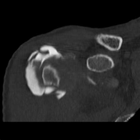 Rotator Cuff Tear Mri Arthrogram - cloudshareinfo