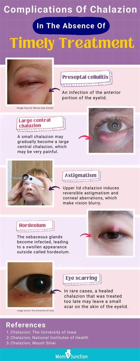 What Is A Chalazion (Bump On Eyelid)? | edu.svet.gob.gt