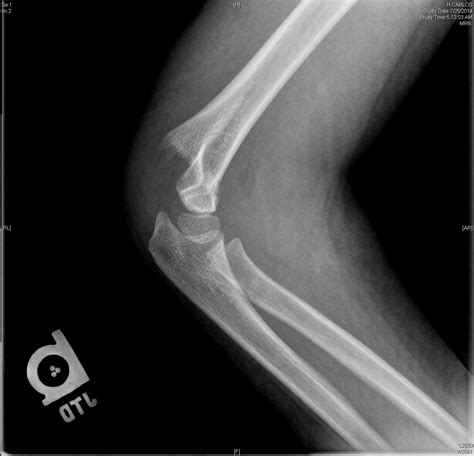 Supracondylar Fracture - Pediatric - Pediatrics (2023)