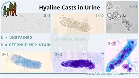 Hyaline Casts: Definition, Causes, Significance, and Clinical Correlations