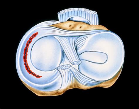 Artwork Of Torn Knee Cartilage In Sports Injury Photograph by John Bavosi - Fine Art America