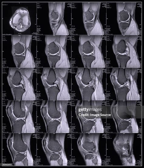 Mri Scans Of A Knee High-Res Stock Photo - Getty Images