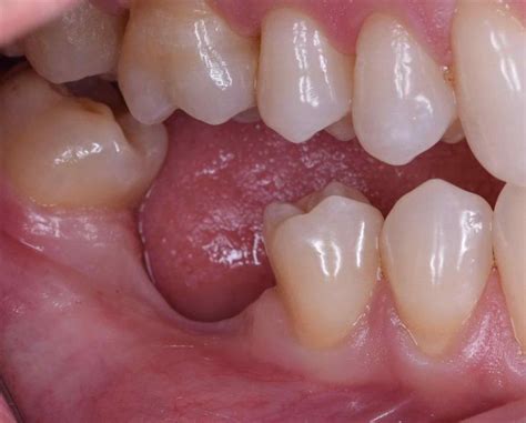 What are the consequences of early first-molar extraction?