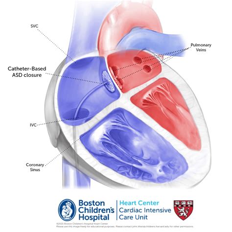 Catheter-Based-ASD-Closure-5 – Online supplement