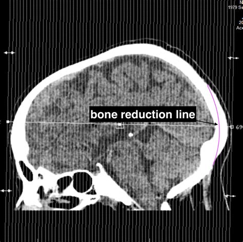 Plastic Surgery Case Study - Male Occipital Bun Skull Reduction - Explore Plastic Surgery