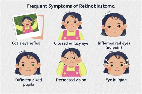 Retinoblastoma: Signs, Symptoms, and Complications