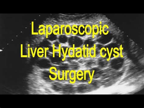 Liver hydatid cyst: Laparoscopic surgery : Dr Keyur Bhatt - YouTube