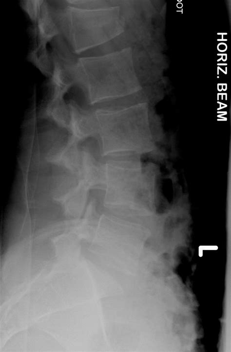 Vertebral Column: Unstable Vertebral Column