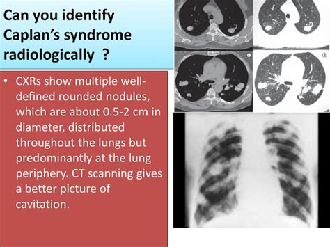 Caplan syndrome,what to know?