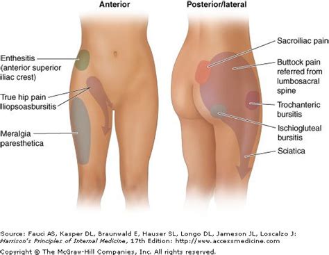 enthesitis hip pain - Google Search | Buttocks pain, Hip pain relief, Hip pain