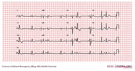 Electrocardiogram Showed Ectopic Atrial Rhythm Atrial Premature ...