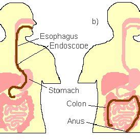 a) Upper endoscopy and b) colonoscopy (lower endoscopy) procedure... | Download Scientific Diagram