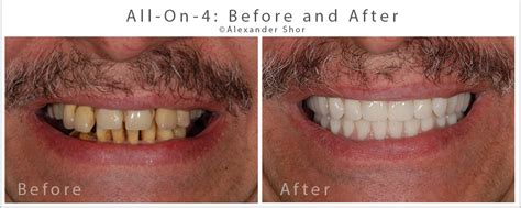 All on 4 Dental Implants Before & After Seattle | Shor Dental