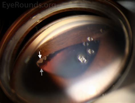 Atlas Entry - High peripheral anterior synechia in iridocorneal endothelial syndrome