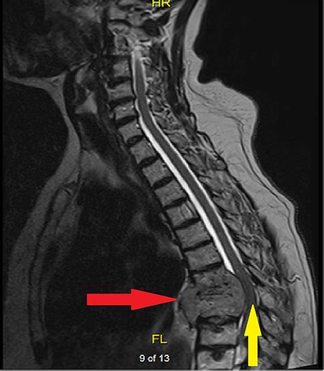 Extramedullary Plasmacytoma Causing Myelopathy Resulting in Gait Imbalance | Cureus